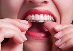 woman putting on her invisalign