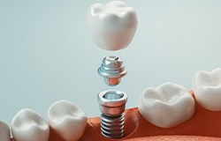 An illustration of the parts of a dental implant