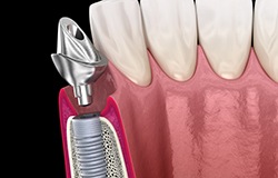 A 3D illustration of a dental implant’s abutment
