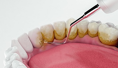 3D render of a dental cleaning