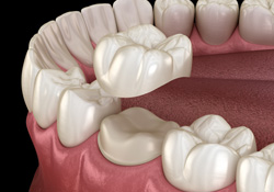 A 3D illustration of the dental crown process