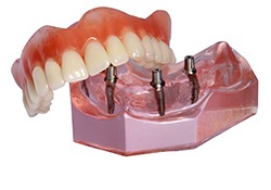 Model of implant denture