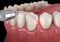 A 3D illustration of the scaling and root planing process
