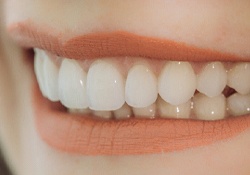 Closeup of woman smiling with veneers in Bartlesville