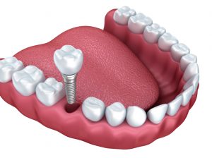 Animation of smile restored with dental implants