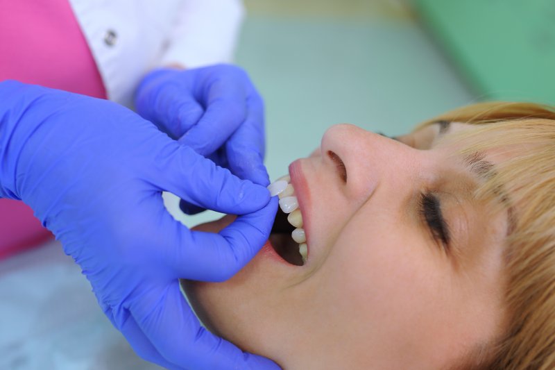A woman having her veneers placed on her teeth