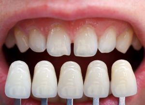 Comparison of patient’s natural teeth to a set of flawless dental veneers